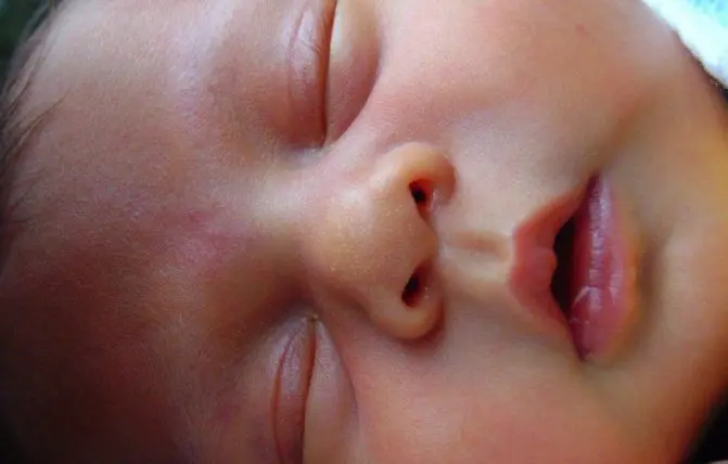 bambino affetto da mughetto