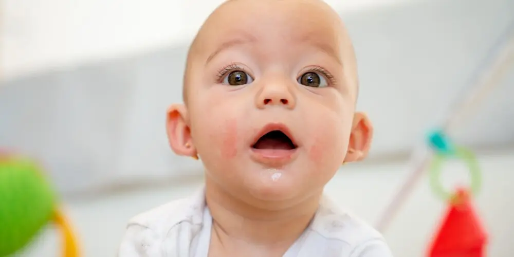 orticaria nei bambini