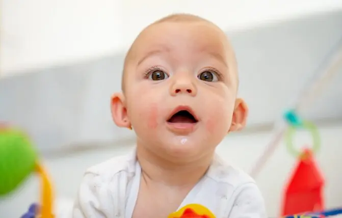 orticaria nei bambini